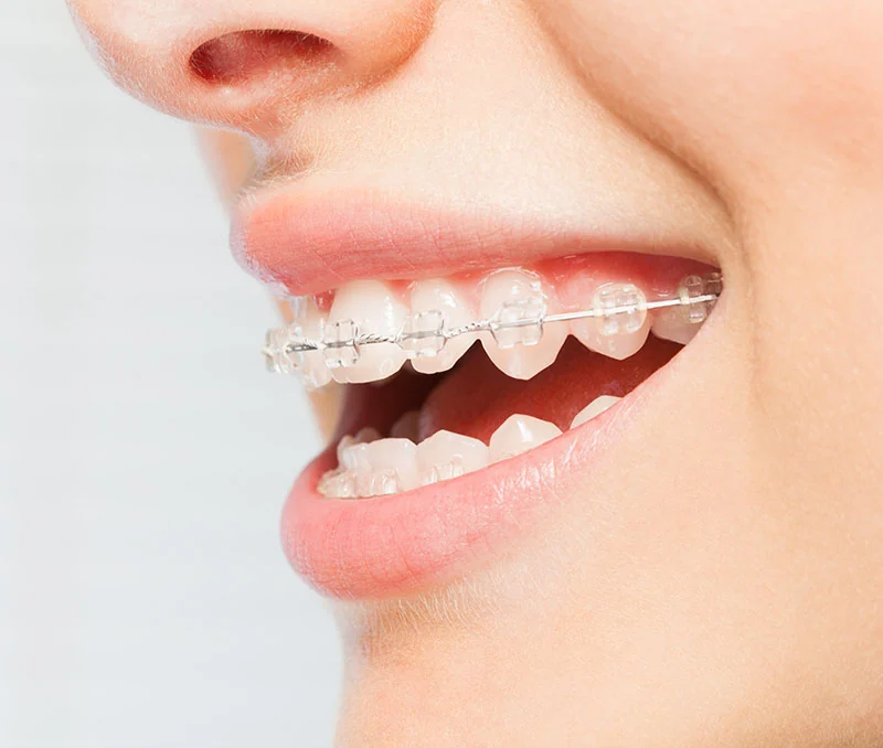 Close-up smile with clear ceramic braces that blend with the teeth