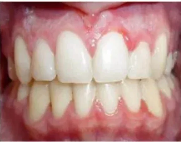 Case 1: smile after orthodontic treatment