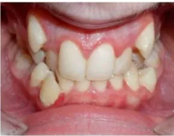Case 1: smile before orthodontic treatment