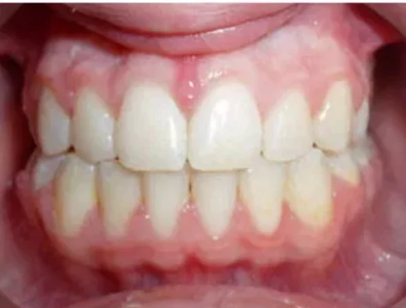 Case 2: smile after orthodontic treatment