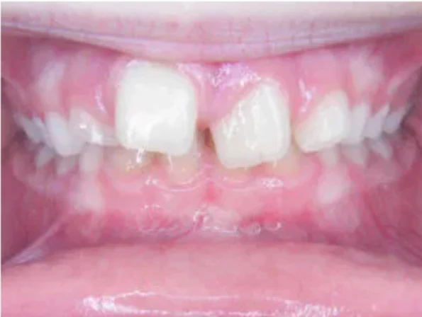 Case 2: smile before orthodontic treatment