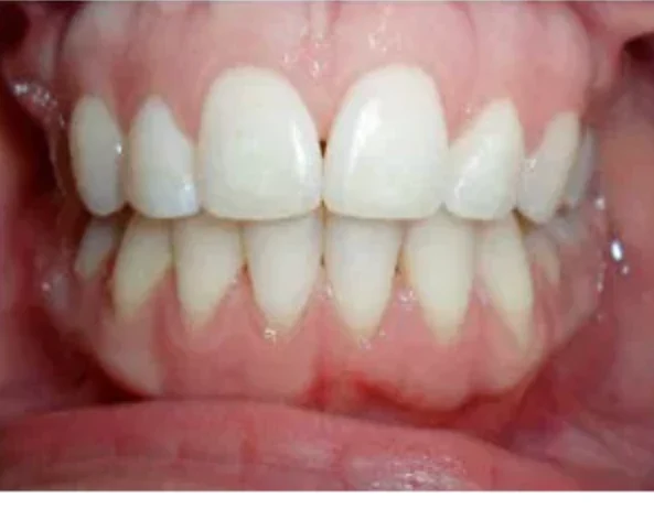 Case 3: smile after orthodontic treatment