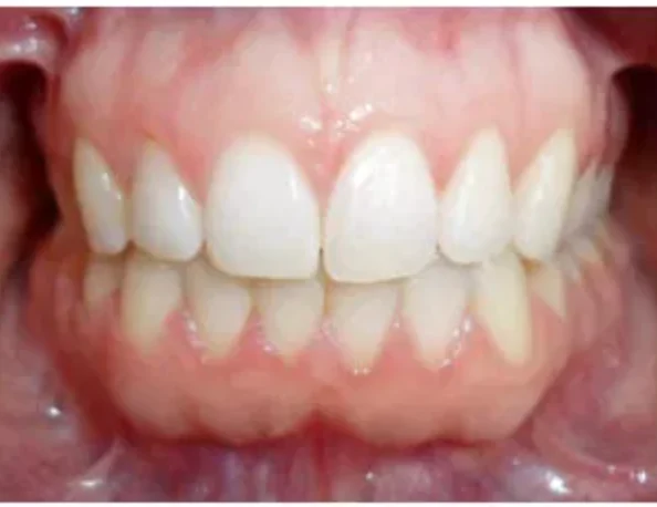 Case 4: smile after orthodontic treatment