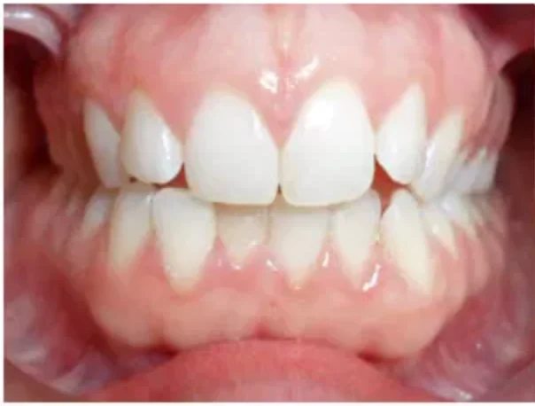 Case 4: smile before orthodontic treatment