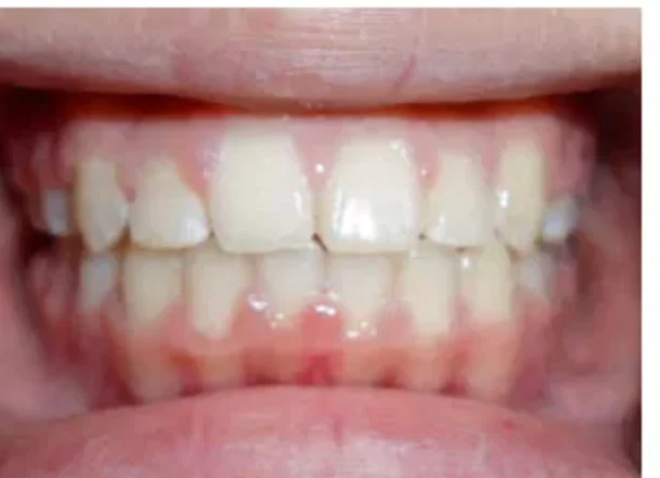 Case 5: smile after orthodontic treatment