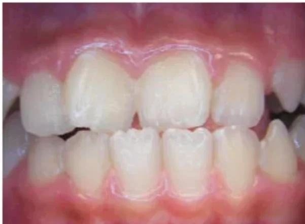 Case 5: smile before orthodontic treatment